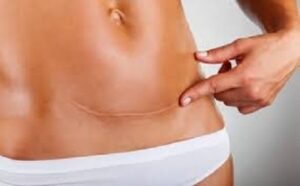 mini abdominoplastie Turquie